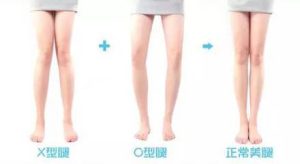 o型腿和x型腿真人图 o型腿和x型腿的体操矫正法