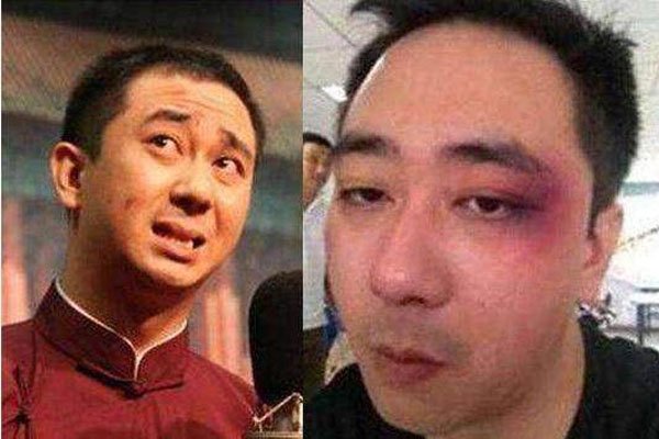 王自健被老婆打的照片 遭到了妻子薛继红的家暴